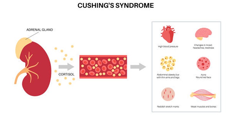 Understanding Cushing's Syndrome: Key Signs and Symptoms to Watch For